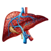 Liver cirrhosis or failure